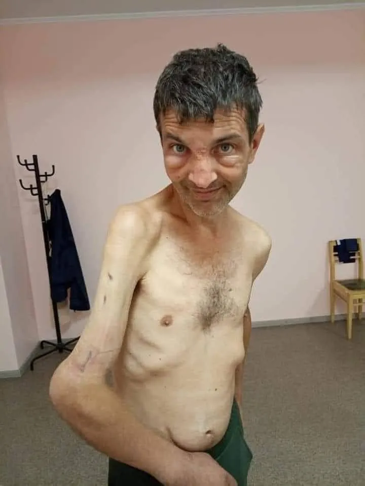 Виснажений Михайло Діанов без сорочки, з викривленою травмованою правою рукою, слабко всміхається